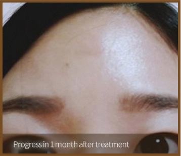 Progress in 1 month after treatment