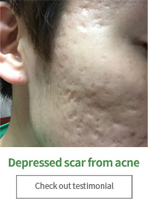 Depressed scar from acne Check out testimonial