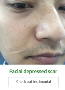 Facial depressed scar Check out testimonial