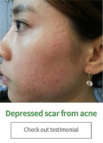 Depressed scar from acne Check out testimonial