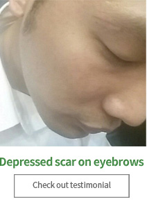 epressed scar on eyebrows Check out testimonial
